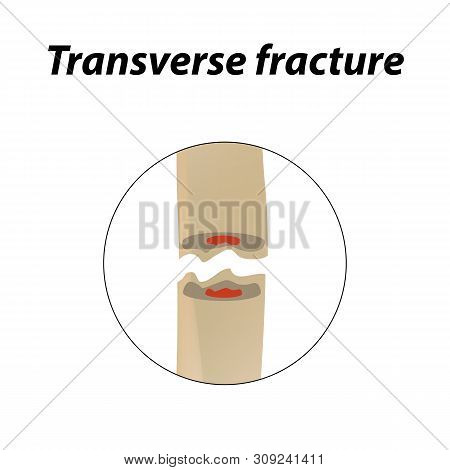 Transverse Bone Fracture. Infographics. Illustration On A Lined Background.