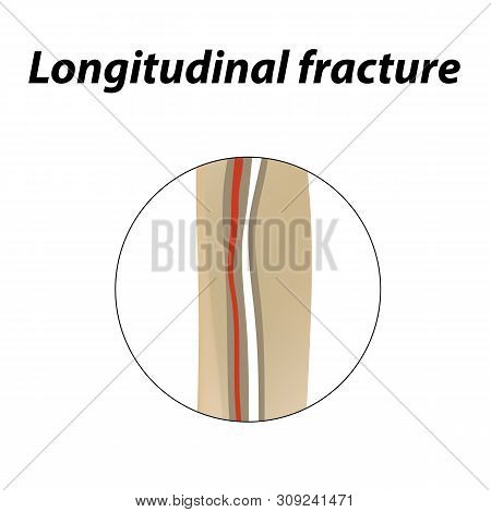 Longitudinal Bone Fracture. Infographics. Illustration On A Lined Background.
