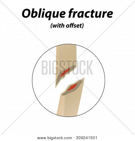 Oblique With Offset Bone Fracture. Infographics. Illustration On A Lined Background.