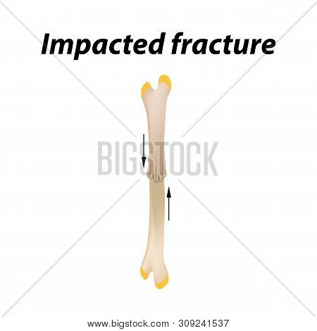 Impacted Fracture Bone. Infographics. Illustration On A Lined Background.