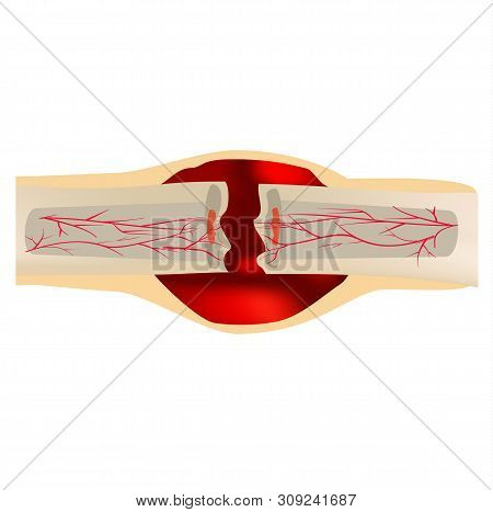 1 Stage Of Healing Bone Fracture. Formation Of Callus. Hematoma. The Bone Fracture. Infographics. Il