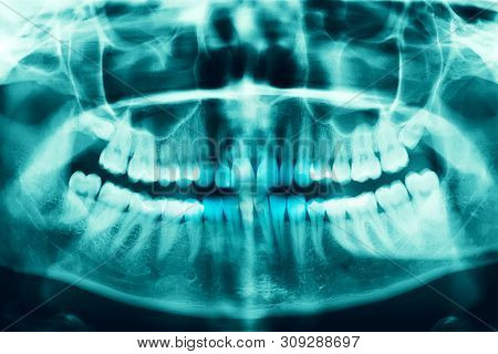 Woman X-ray Of The Teeth Wisdom Teeth Horizontal Pozition Problem Dentistry Medicine. Panoramic Imag