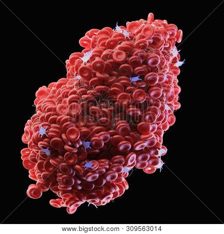 3d rendered medically accurate illustration of a blood clot