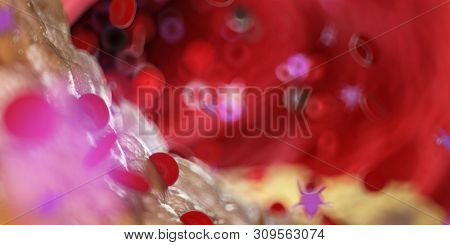 3d rendered medically accurate illustration of a capped plaque in a human artery