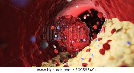 3d rendered medically accurate illustration of a thrombus emerging from a capped plaque