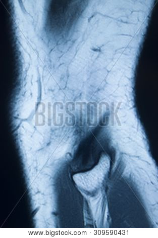Knee Injury Mri Mcl Tear