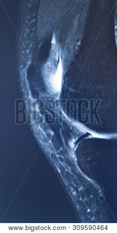 Knee Injury Mri Mcl Tear