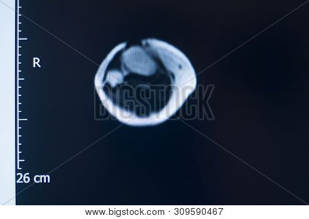 Knee Injury Mri Mcl Tear