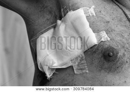 Department Of Oncology Surgery. The Operation To Remove The Guard Lifusla. The Diagnosis Is Malignan