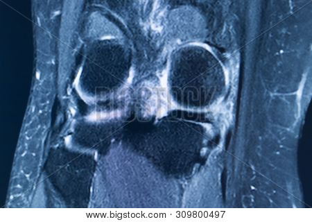 Knee Injury Mri Mcl Tear
