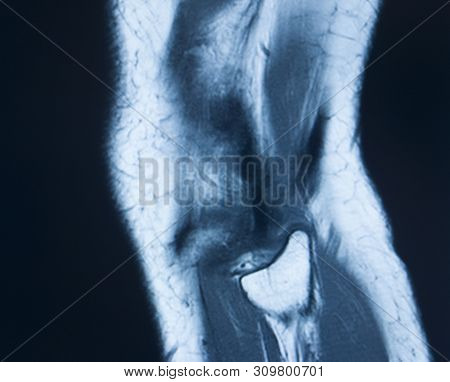 Knee Injury Mri Mcl Tear
