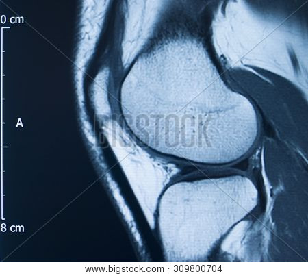 Knee Injury Mri Mcl Tear