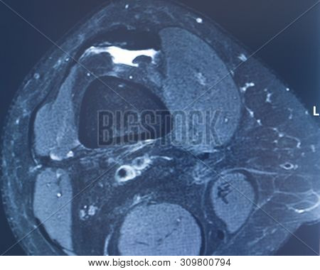 Knee Injury Mri Mcl Tear