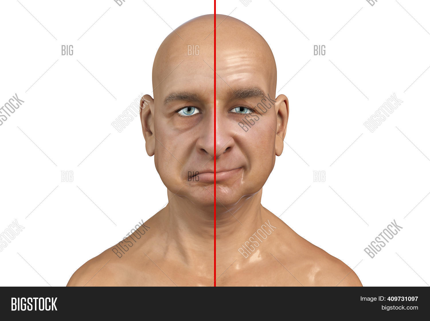 Facial Nerve Paralysis Image & Photo (Free Trial) Bigstock