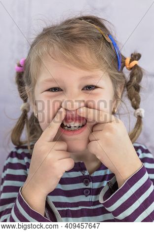 Adult Permanent Teeth Coming In Front Of The Child's Baby Teeth: Shark Teeth. Little Girl's Open Mou