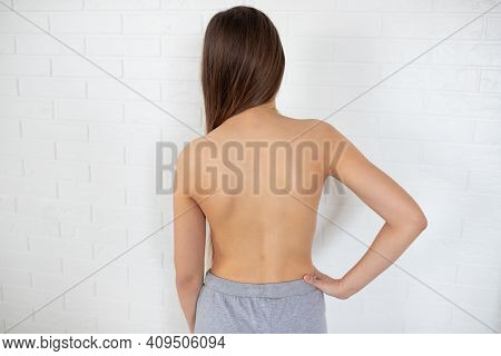Scoliosis In Adolescents. Poor Posture In A Teenage Girl. How To Check Your Posture At Home. Lordosi