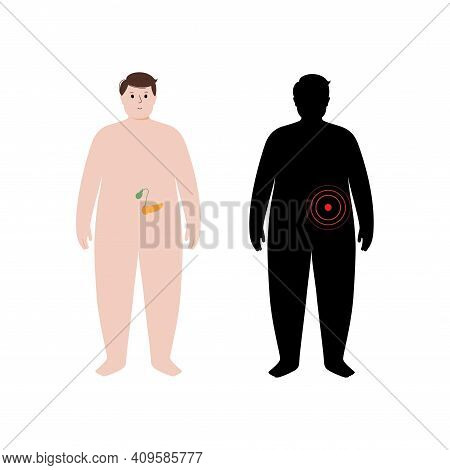 Pain, Inflammation In Pancreas. Adult Obese Man Anatomy Poster. Diabetes, Ache In Overweight Male Hu