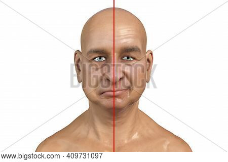 Facial Nerve Paralysis, Bells Palsy, 3d Illustration Showing Male With One-sided Facial Nerve Paraly