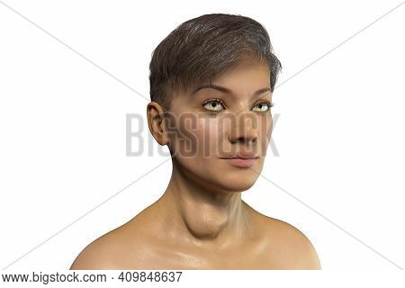 Thyroid Tumor, 3d Illustration Showing Nodule Inside Thyroid Gland