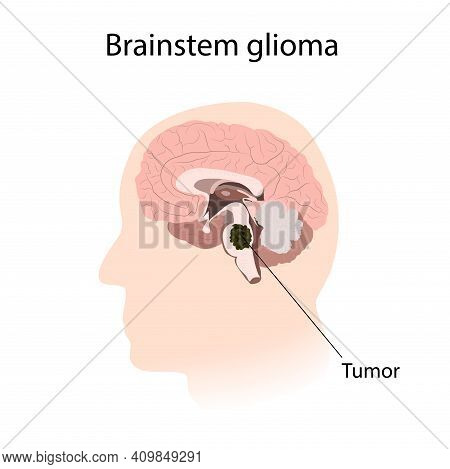 Brainstem Glioma. Brain Cancer, Tumor With Explanations.