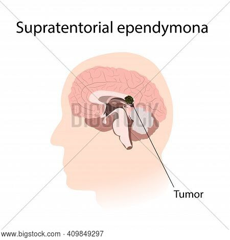 Supratentorial Ependymona. Brain Cancer, Tumor With Explanations.