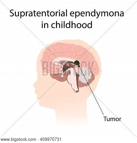 Supratentorial Ependymona In Childhood. Brain Cancer, Tumor With Explanations.
