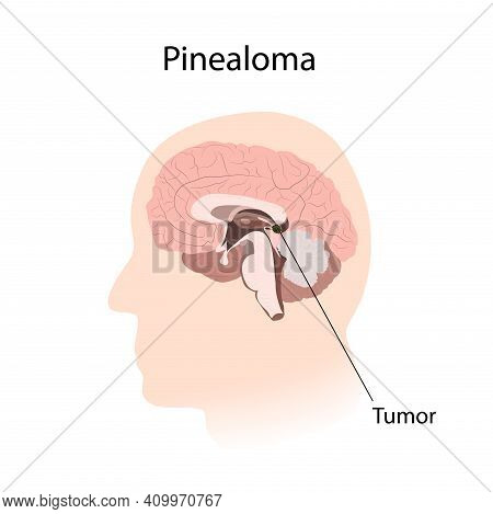 Pinealoma. Brain Cancer, Tumor With Explanations. Inner View.