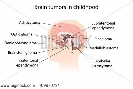 Brain Cancer, Tumor With Explanations. Sihuette Of Kid Child Head, Inner View.