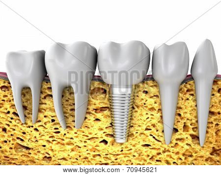 Jaw Bone