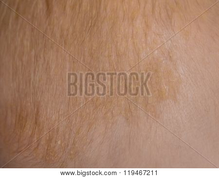 seborrheic dermatitis