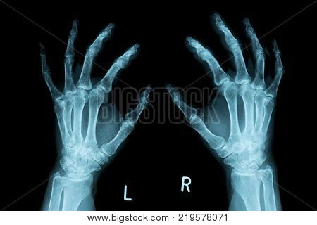 both human hands X-ray image from a human body part for medical diagnosis. ideal for websites and magazines layouts