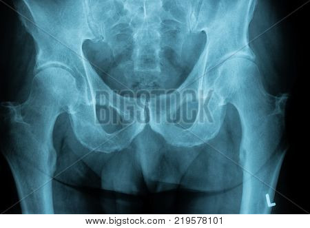 Human Chest X-ray image from a human body part for medical diagnosis. ideal for websites and magazines layouts