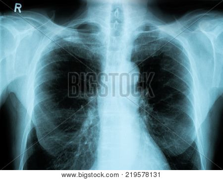Chest X-ray image from a human body part for medical diagnosis. ideal for websites and magazines layouts