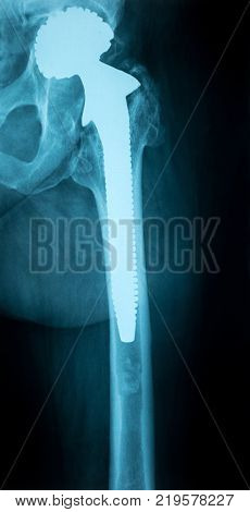 right Chest with Artificial hip joint X-ray image from a human body part. ideal for websites and magazines layouts