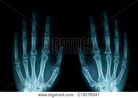 left and right hand X-ray image from a human body part. ideal for websites and magazines layouts