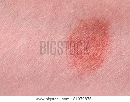 The great red spot on the skin closeup.