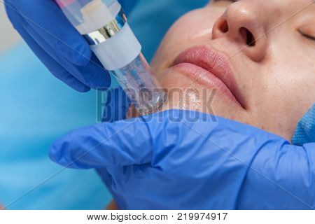 Cosmetic treatment by injection in the clinic. Use of a dermal injector to stimulate the skin. A woman receives injections of a placental-peptide serum