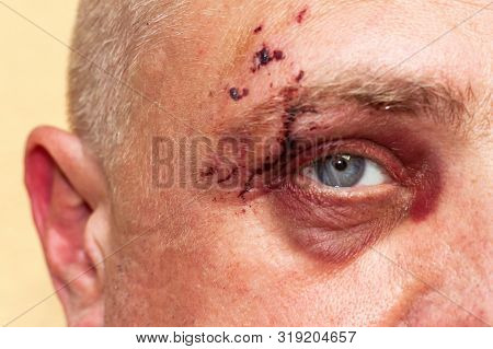 Male Eye With A Large Purple Bruise. Biting Dog On Face. Eye Injury. Large Bruising On The Male Eye.