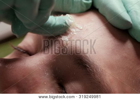 Sugaring. Epilation. A Beautician With Gloves Sharply Tears Off A Piece Of Sugar Paste Along With Th