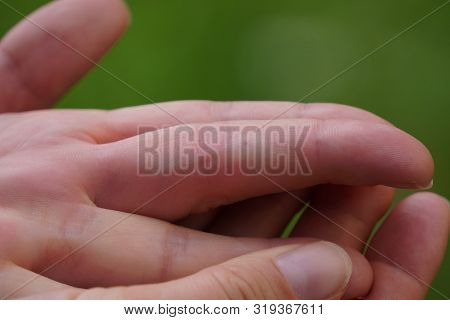 The Bite Of A Wasp Or Bee On The Finger, The Place Of The Bite Is White And Swollen. Care Stung Plac