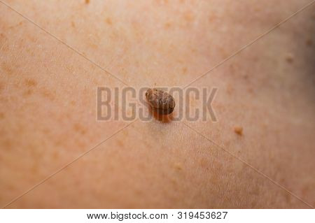 Papilloma On The Skin Of A Woman’s Neck. Soft Focus, Shallow Depth Of Field.