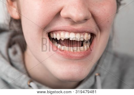 Problem Teeth At The Young Girl. A Curve Row And The Wrong Bite An Occasion To Visit The Dentist And