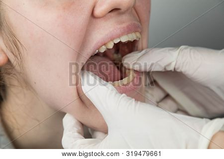 Caucasian Woman At A Dentist's Doctor's Appointment. Oral Examination. The Dental Row Is Clearly Vis