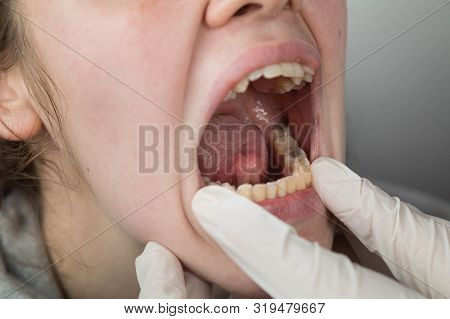 Caucasian Woman At A Dentist's Doctor's Appointment. Oral Examination. The Dental Row Is Clearly Vis