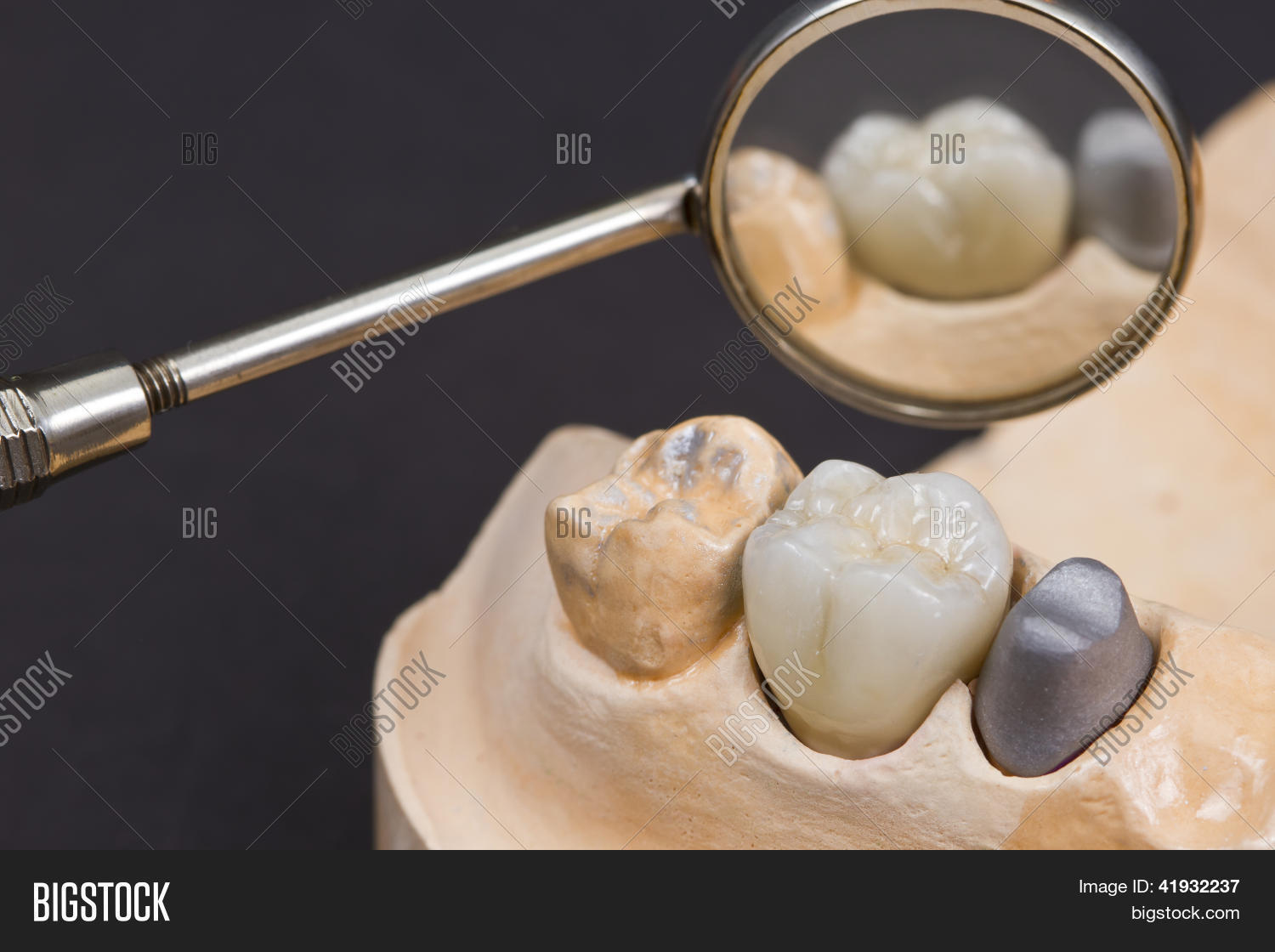 Ceramic Crown Molar Image & Photo (Free Trial) Bigstock