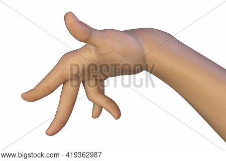 A Hand Of A Child With Chorea, A Hyperkinetic Movement Disorder. 3d Illustration Showing Brief, Irre