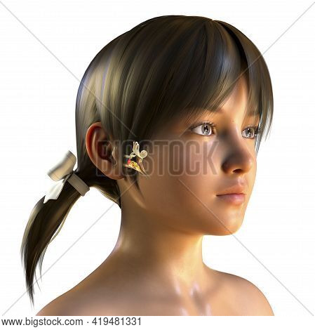 Otitis Media, A Group Of Inflammatory Diseases Of The Middle Ear, 3d Illustration Showing A Girl Wit