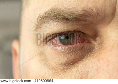 Red And Inflamed Eye Close-up. Patient's Red Eye. Allergic Reaction