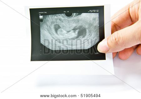 12 Weeks Baby Ultrasound Image