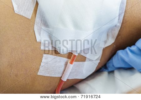 Tube Of Fluid Drain From Patient
